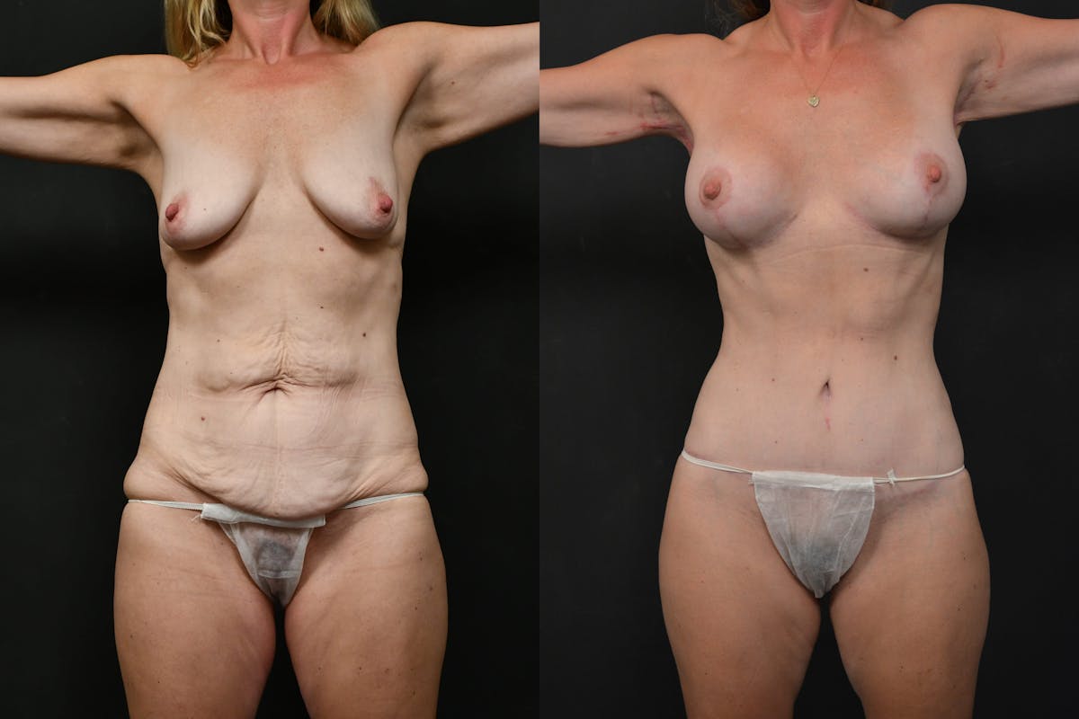 Mommy Makeover Before & After Gallery - Patient 115526 - Image 1