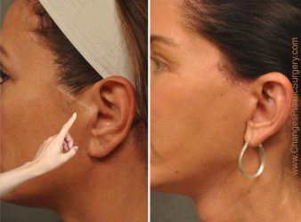 Visible Scars vs non-visible