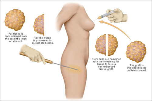 body anatomy during fat grafting