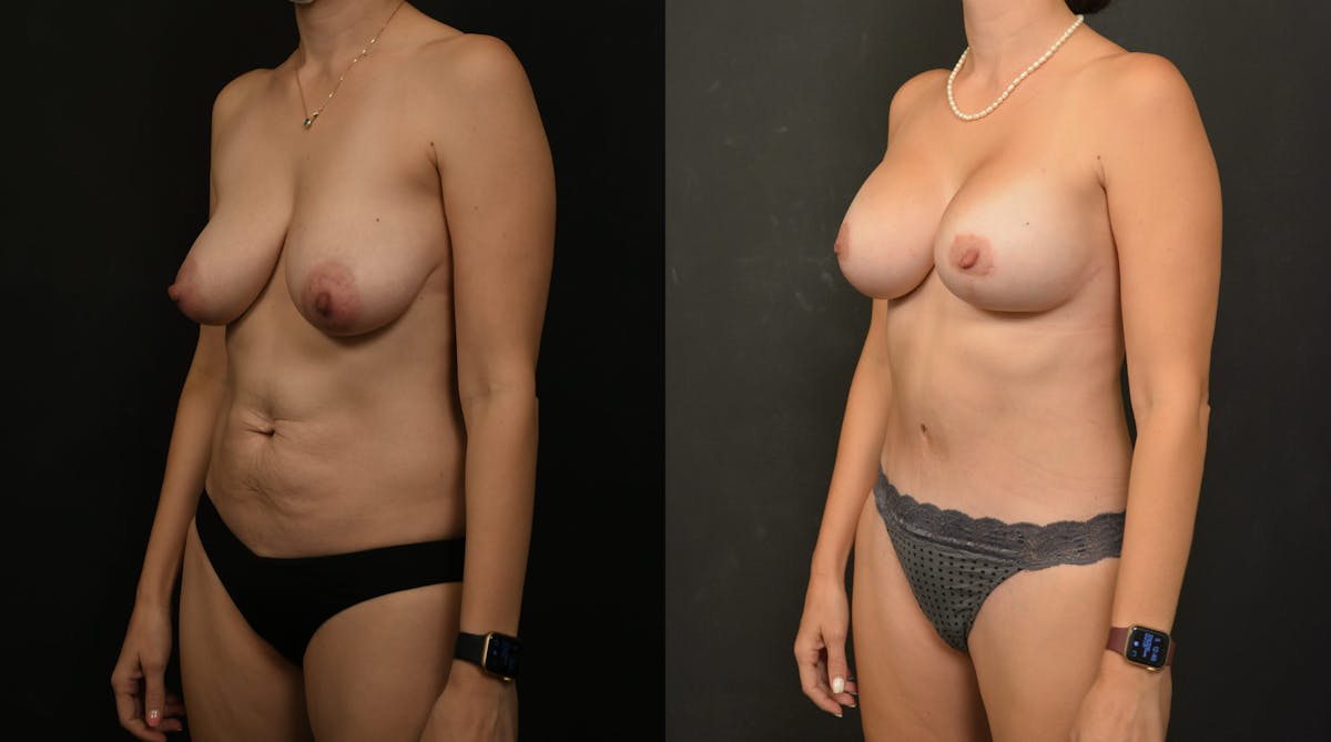 Breast Lift Before & After Gallery - Patient 319269 - Image 2