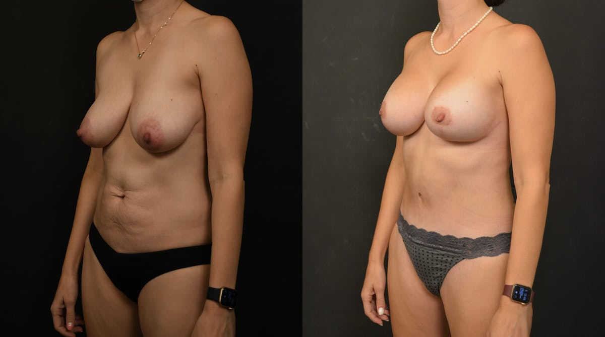 Reductive Augmentation Before & After Gallery - Patient 173376 - Image 2