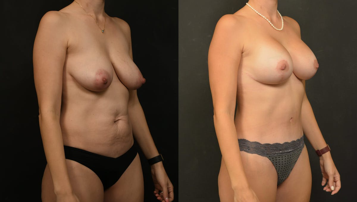 Reductive Augmentation Before & After Gallery - Patient 173376 - Image 4