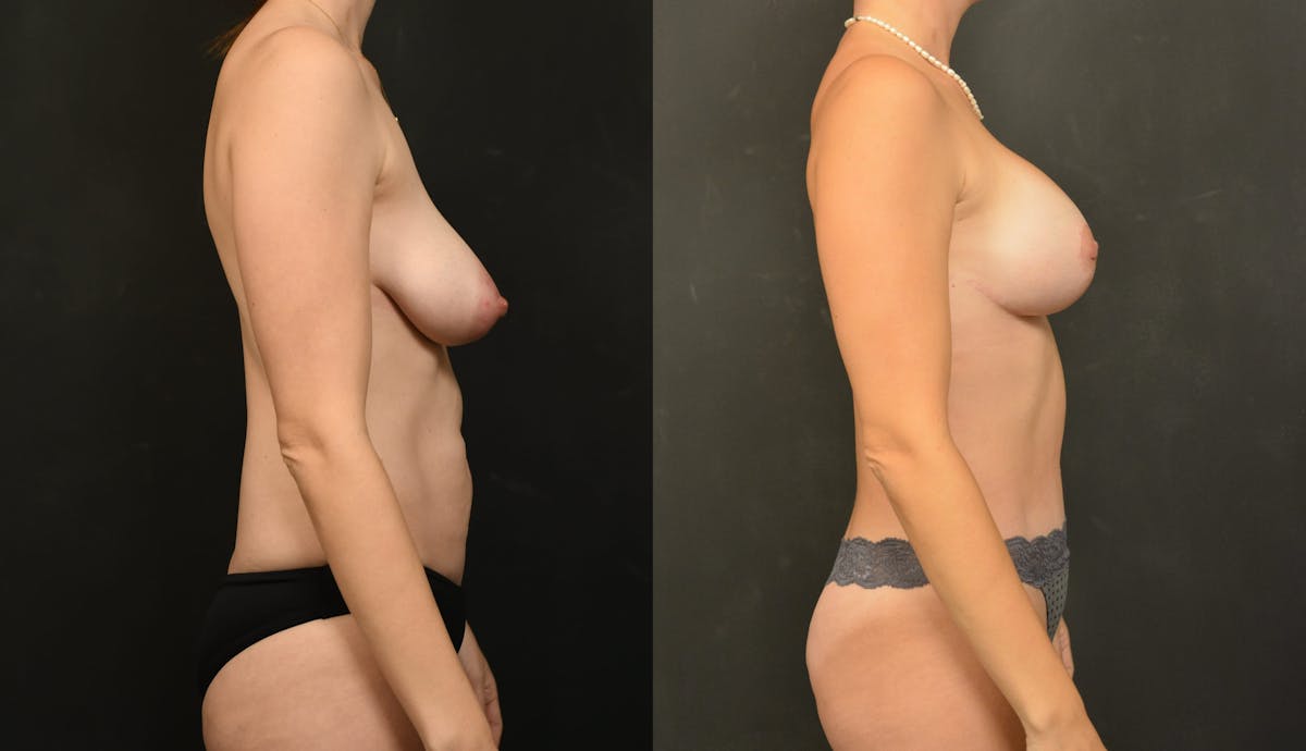Reductive Augmentation Before & After Gallery - Patient 173376 - Image 5