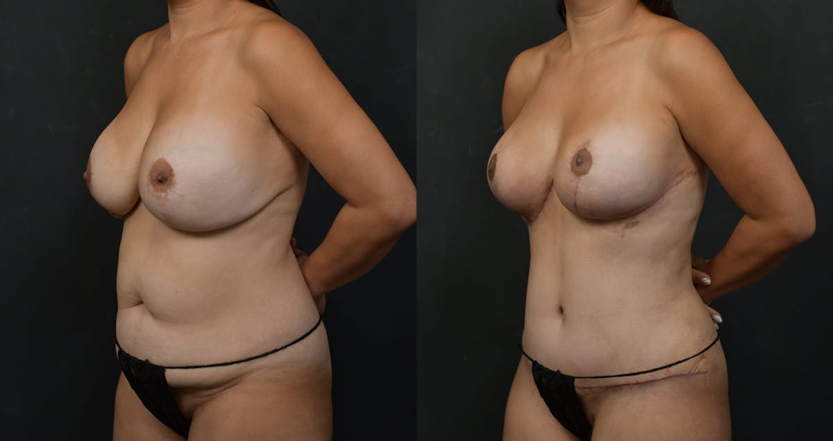 Breast Revision Before & After Gallery - Patient 226357 - Image 2