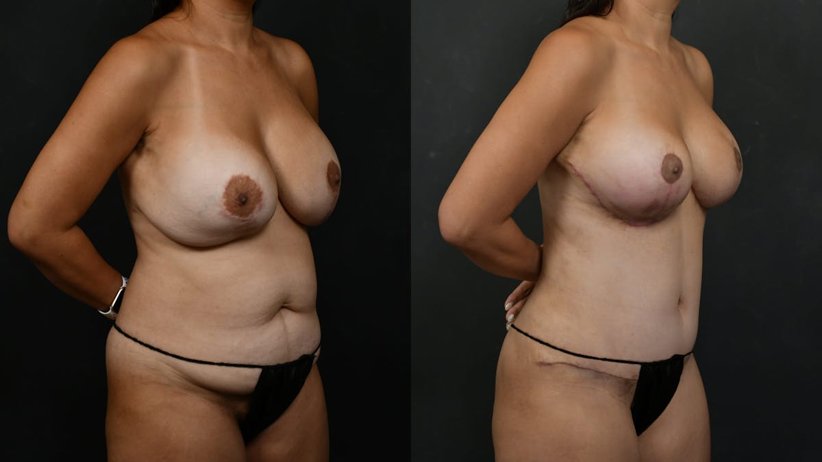 Breast Revision Before & After Gallery - Patient 226357 - Image 4