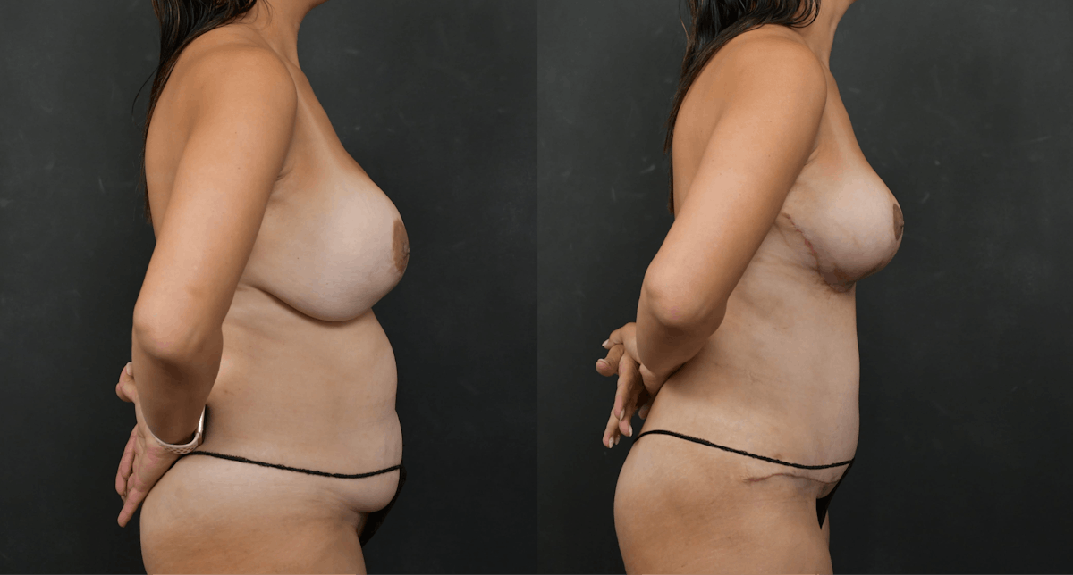 Breast Revision Before & After Gallery - Patient 226357 - Image 5