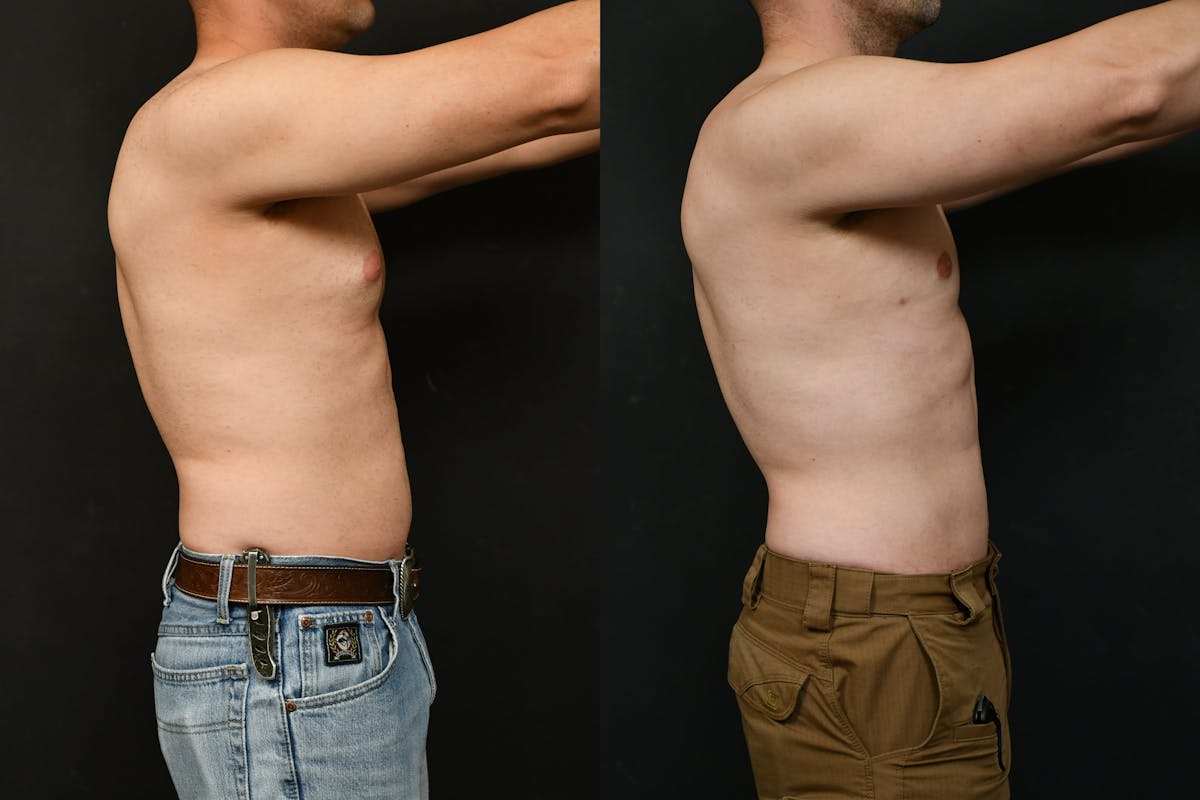 Gynecomastia Before & After Gallery - Patient 737308 - Image 3