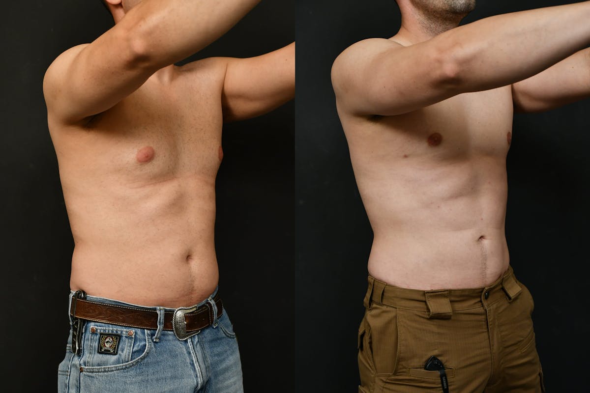 Gynecomastia Before & After Gallery - Patient 737308 - Image 2