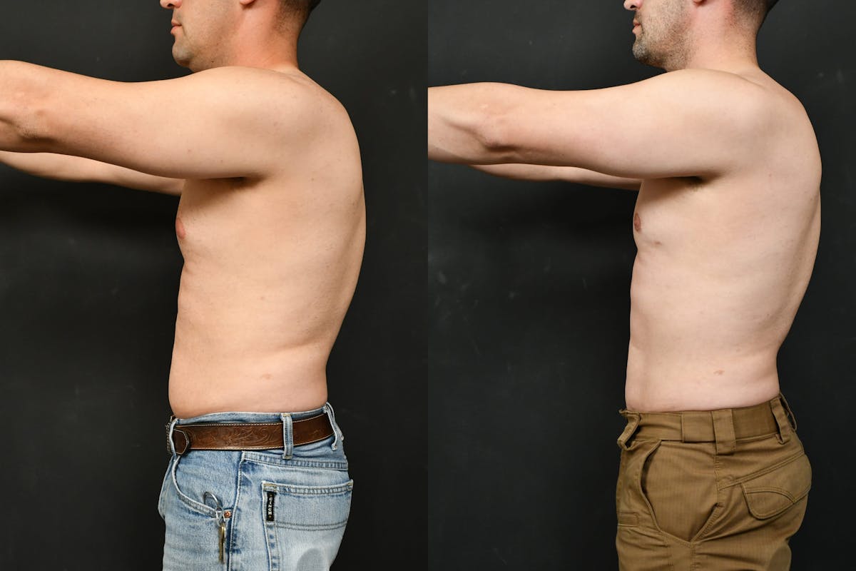 Gynecomastia Before & After Gallery - Patient 737308 - Image 5