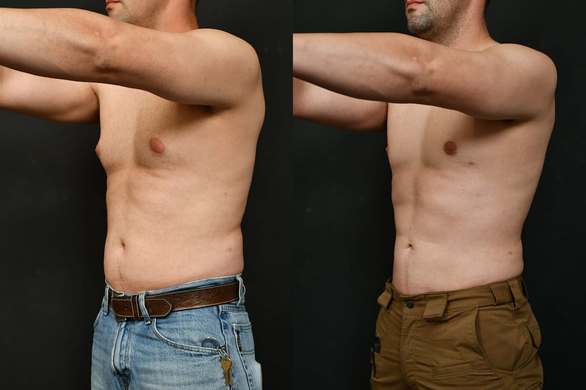 Gynecomastia Before & After Gallery - Patient 737308 - Image 4
