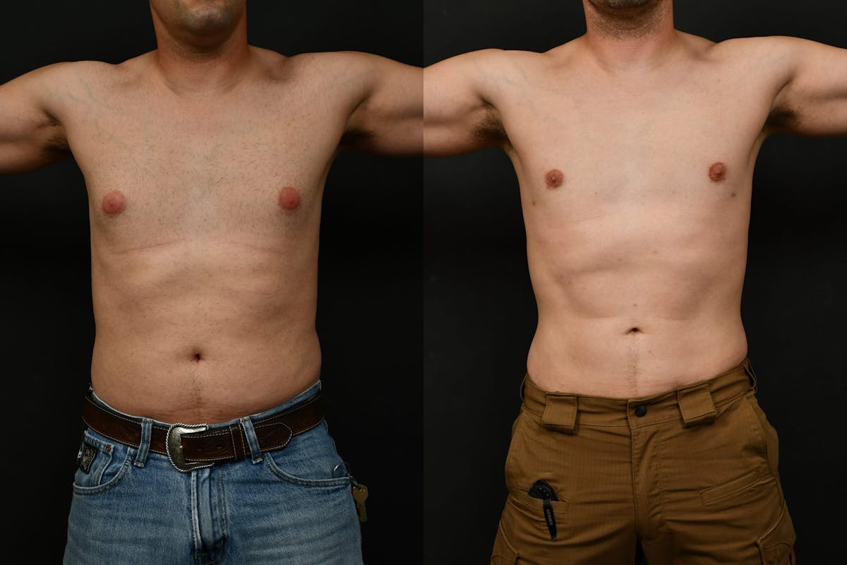 Gynecomastia Before & After Gallery - Patient 737308 - Image 1