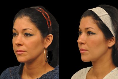 Eyelid Surgery Before & After Gallery - Patient 900539 - Image 1