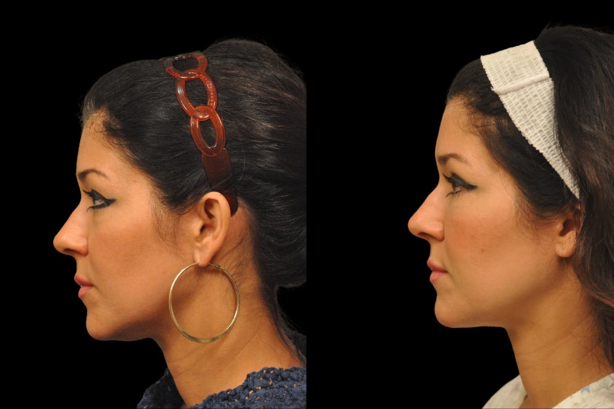 Eyelid Surgery Before & After Gallery - Patient 900539 - Image 2