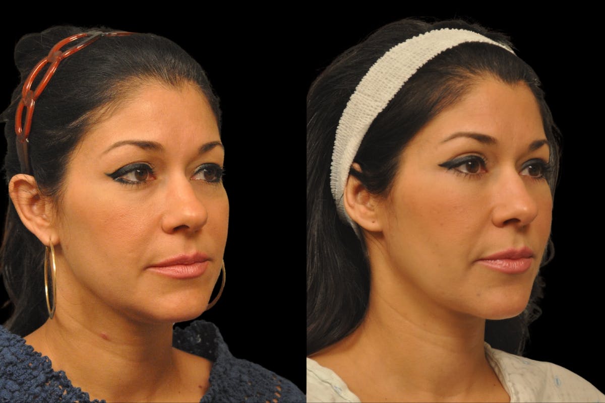 Eyelid Surgery Before & After Gallery - Patient 900539 - Image 3