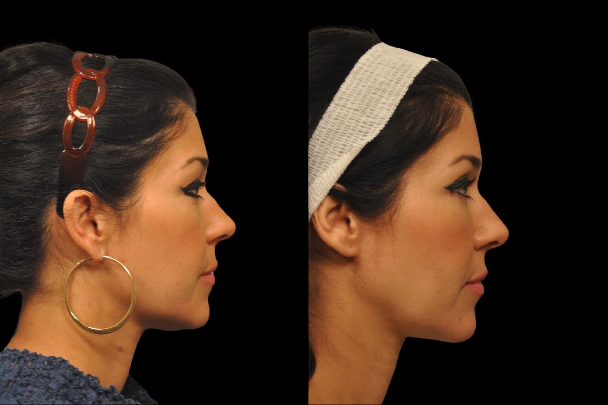 Eyelid Surgery Before & After Gallery - Patient 900539 - Image 4