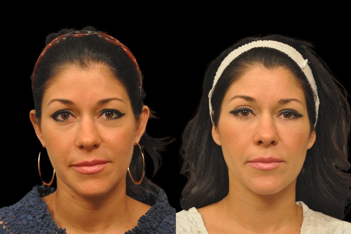 Eyelid Surgery Before & After Gallery - Patient 900539 - Image 5