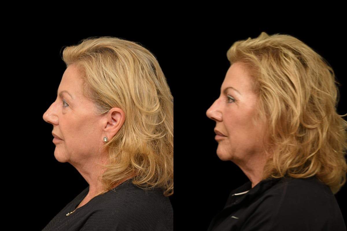 Eyelid Surgery Before & After Gallery - Patient 358426 - Image 5
