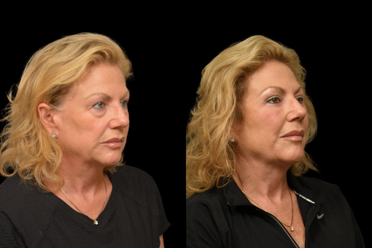 Eyelid Surgery Before & After Gallery - Patient 358426 - Image 7