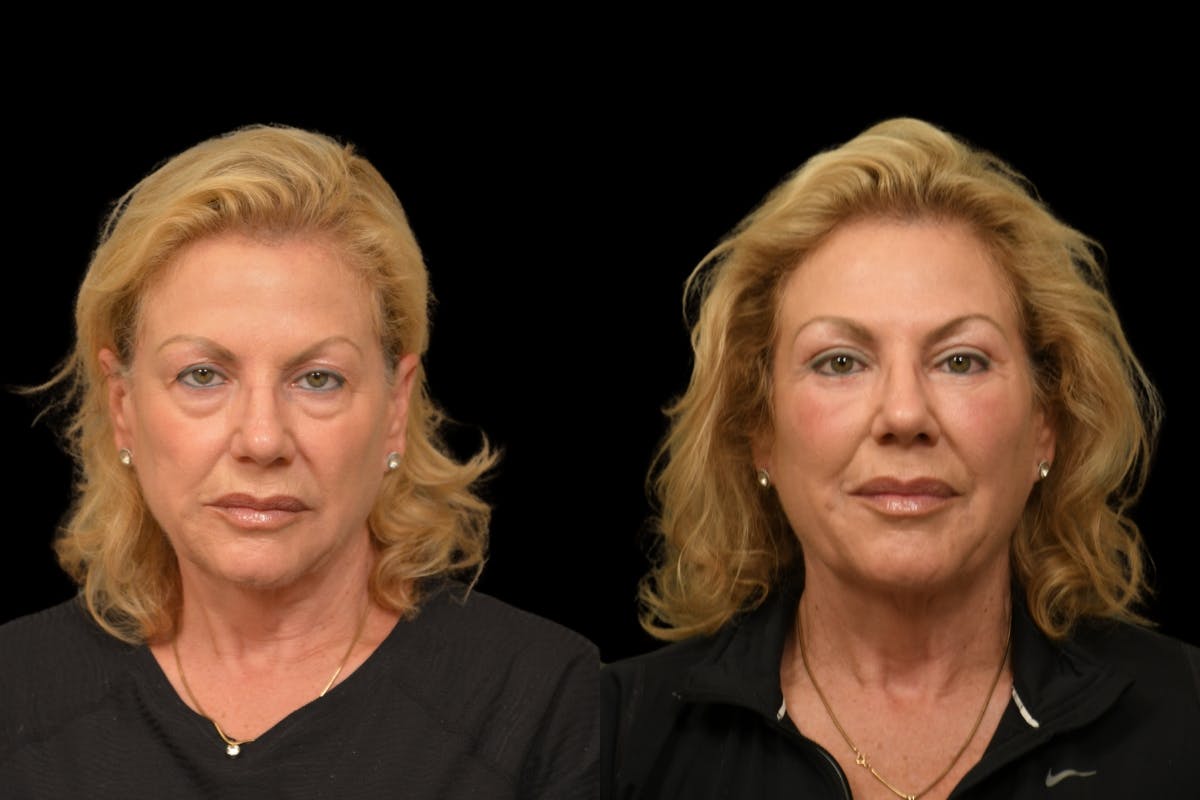 Eyelid Surgery Before & After Gallery - Patient 358426 - Image 10