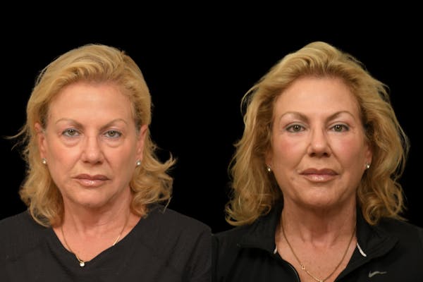 Eyelid Surgery Before & After Gallery - Patient 358426 - Image 1