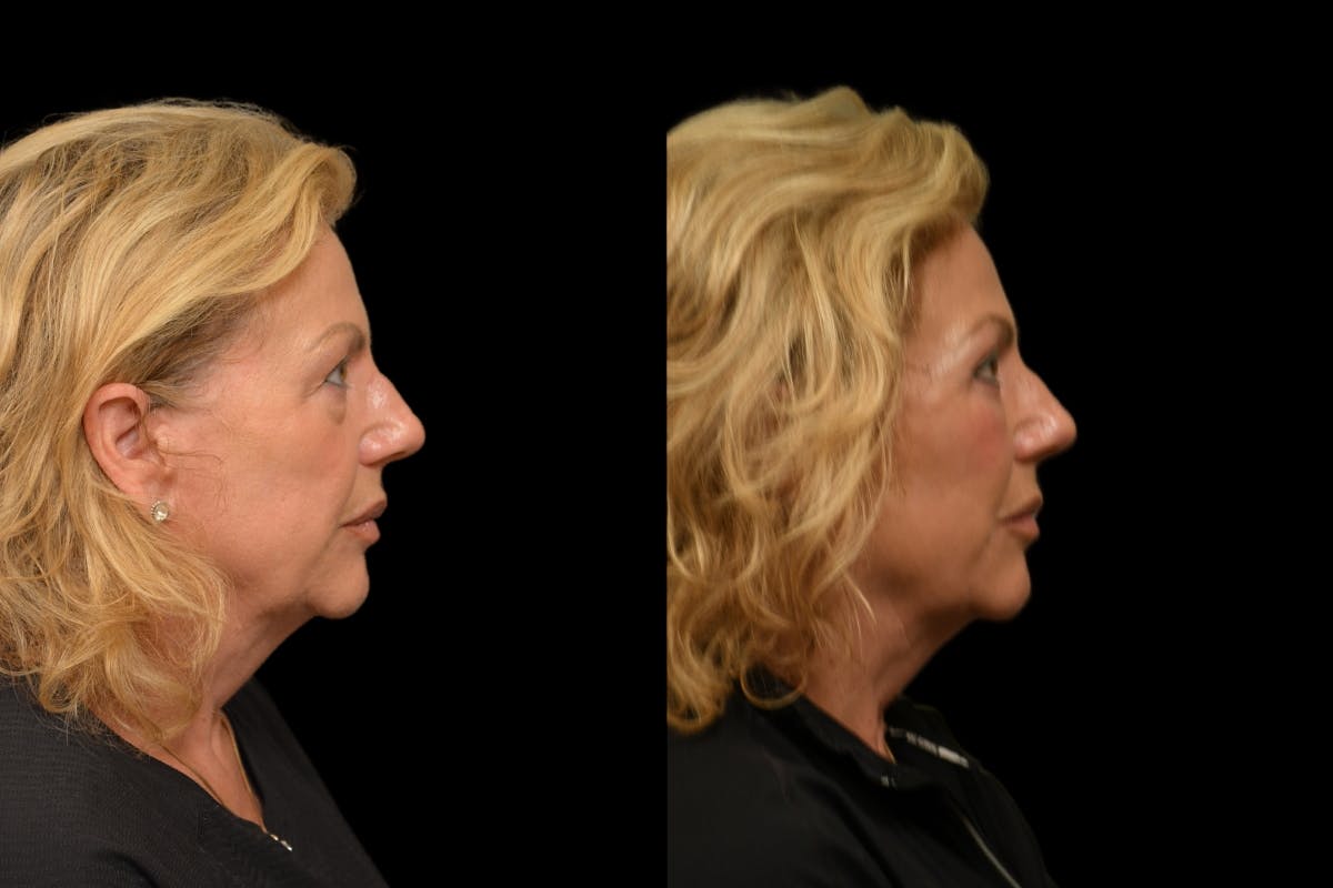 Eyelid Surgery Before & After Gallery - Patient 358426 - Image 8
