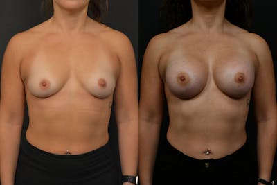 Breast Augmentation Before & After Gallery - Patient 150977 - Image 1