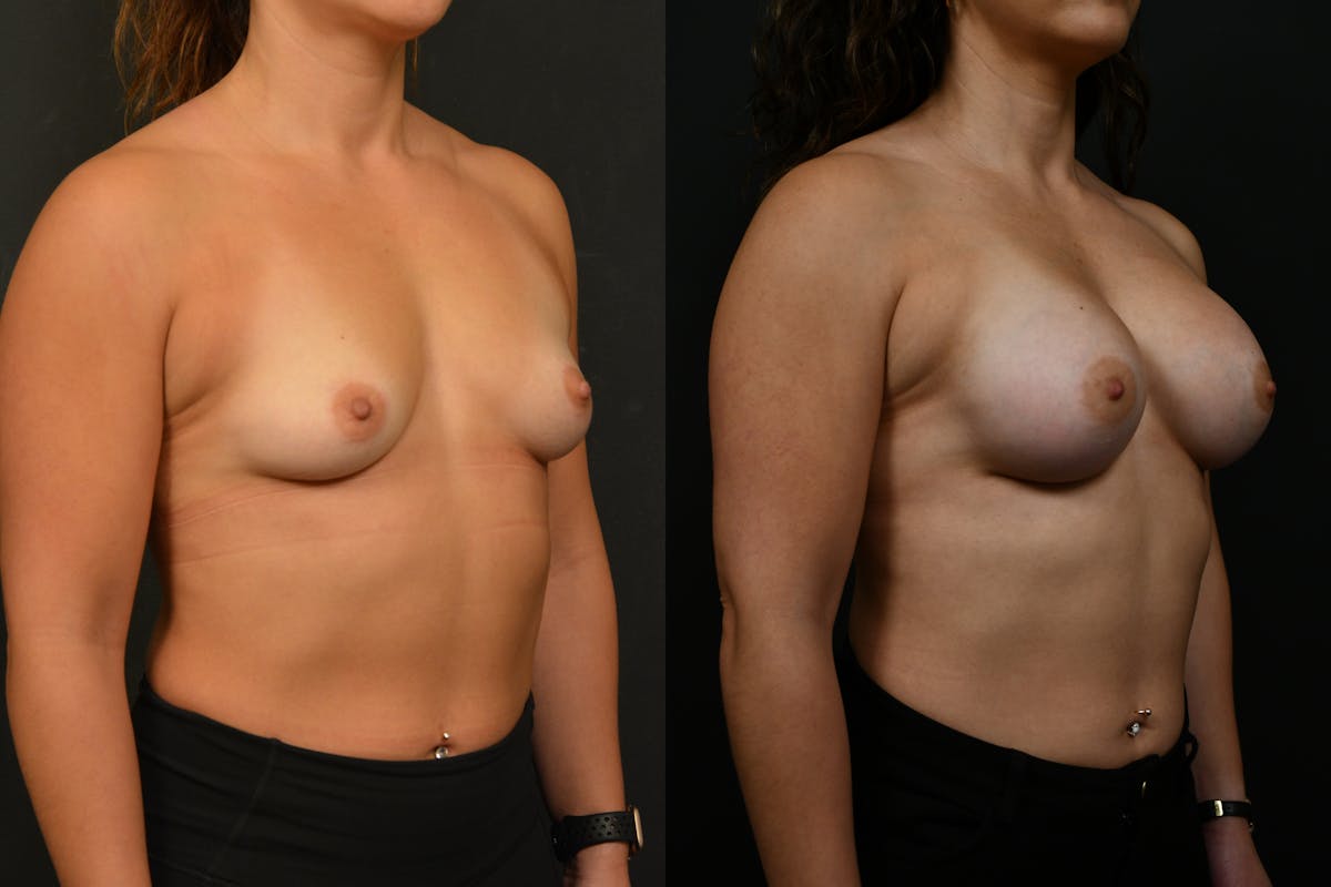 Breast Augmentation Before & After Gallery - Patient 150977 - Image 2