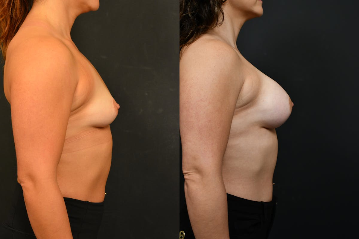Breast Augmentation Before & After Gallery - Patient 150977 - Image 3