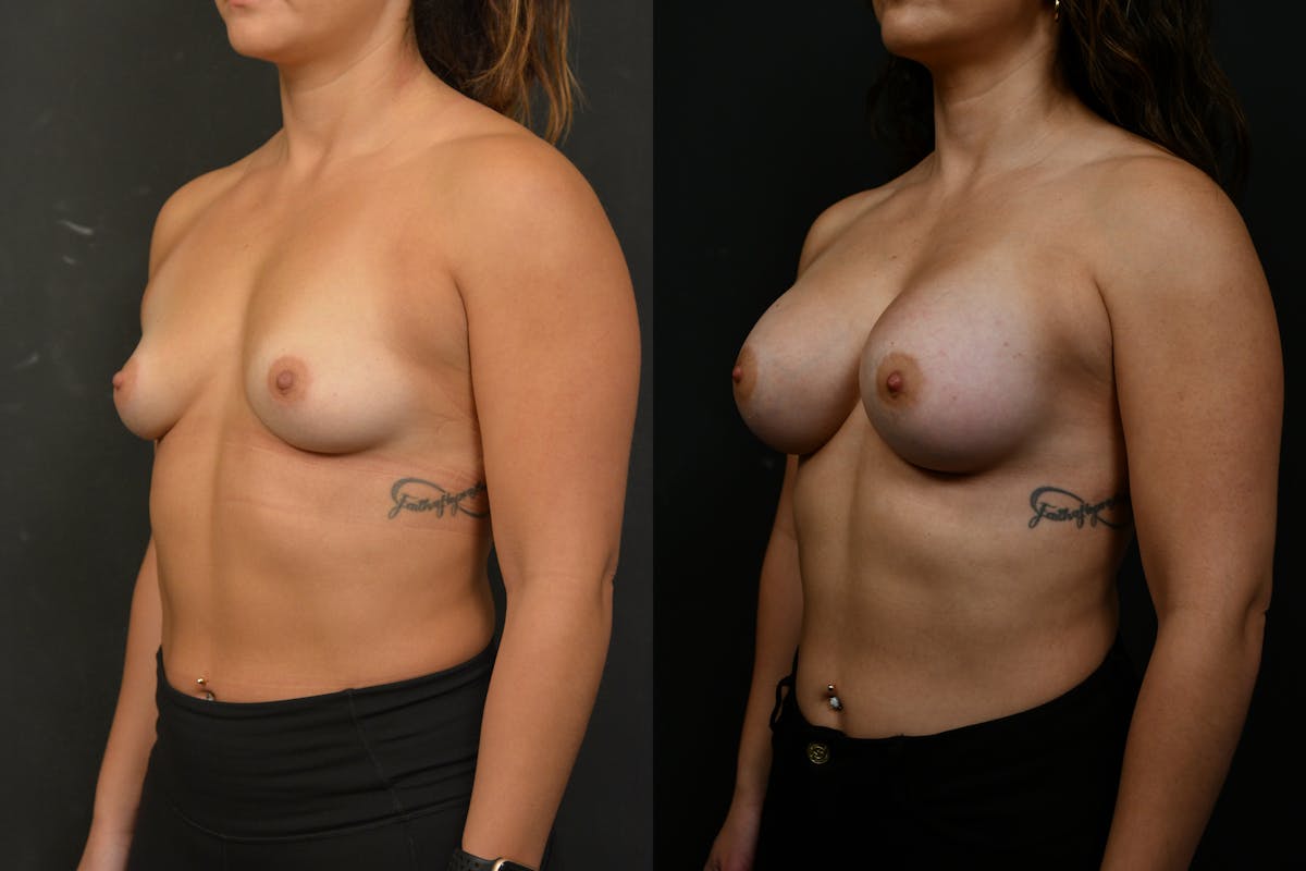 Breast Augmentation Before & After Gallery - Patient 150977 - Image 4