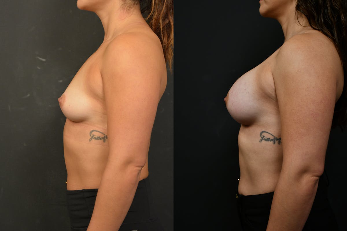 Breast Augmentation Before & After Gallery - Patient 150977 - Image 5