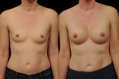 Breast Augmentation Before & After Gallery - Patient 134586 - Image 1