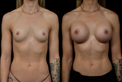 Breast Augmentation Before & After Gallery - Patient 276245 - Image 1