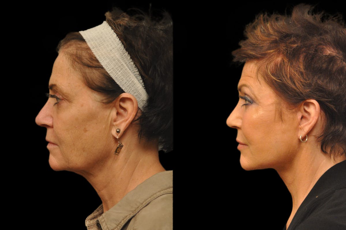 Chemical Peels Before & After Gallery - Patient 319665 - Image 2