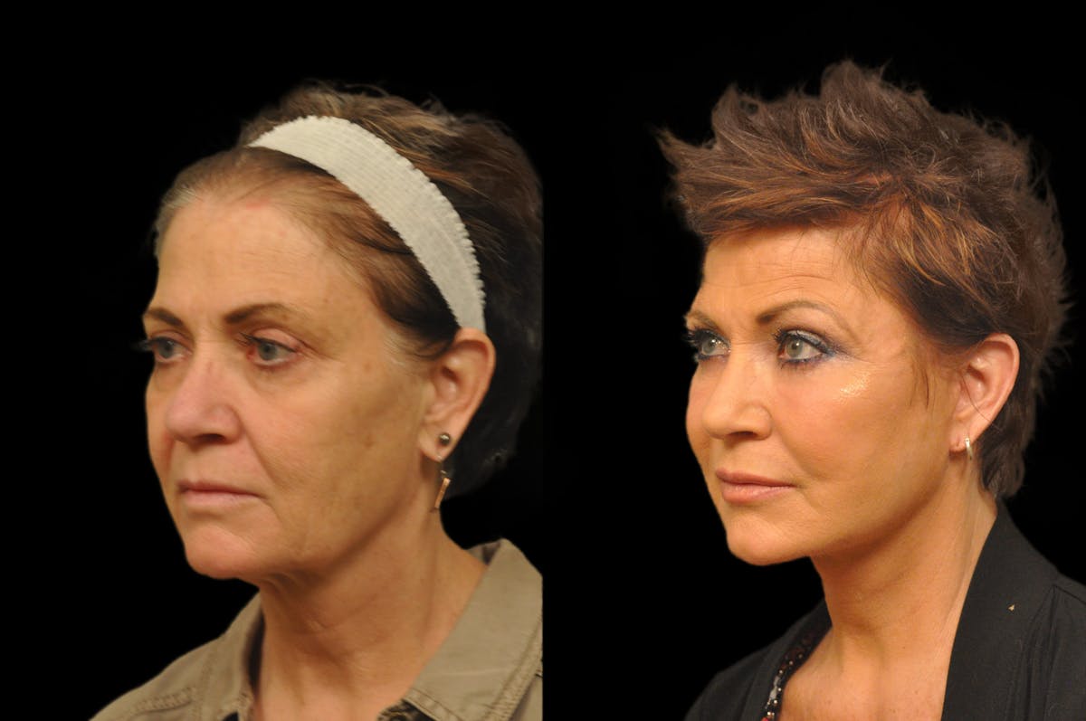 Chemical Peels Before & After Gallery - Patient 319665 - Image 1