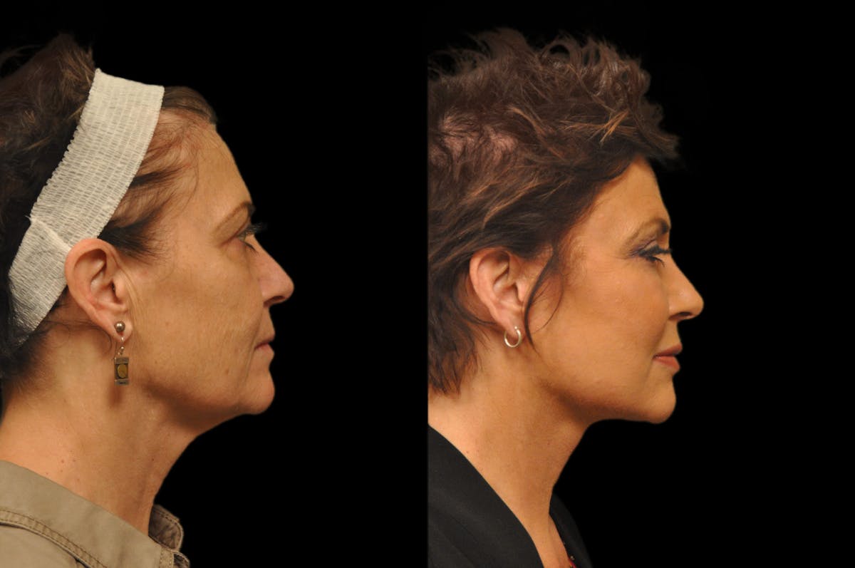 Chemical Peels Before & After Gallery - Patient 319665 - Image 3