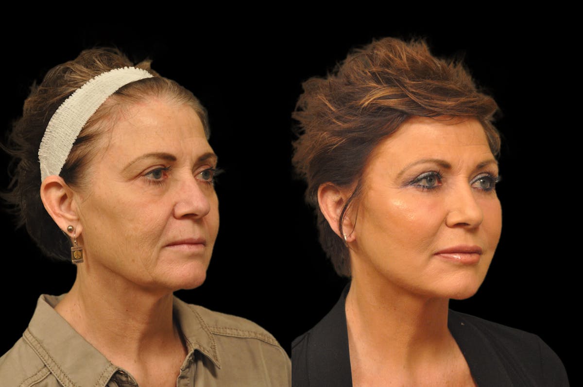 Chemical Peels Before & After Gallery - Patient 319665 - Image 4