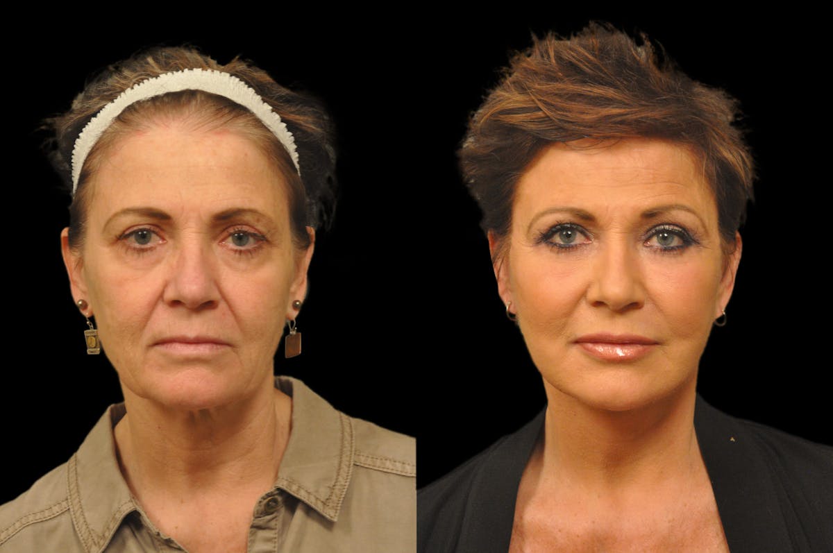 Chemical Peels Before & After Gallery - Patient 319665 - Image 5