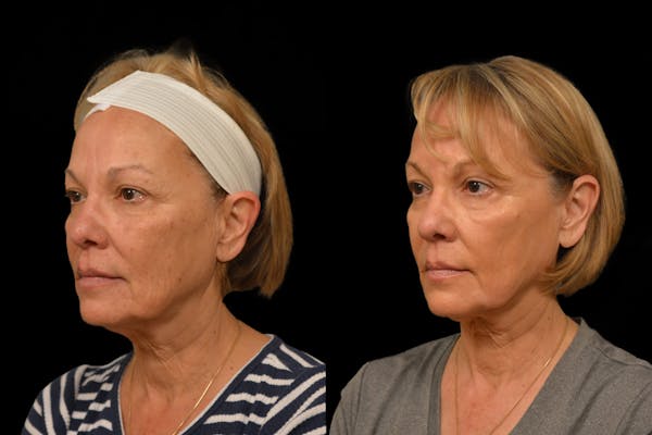 Chemical Peels Before & After Gallery - Patient 317205 - Image 1
