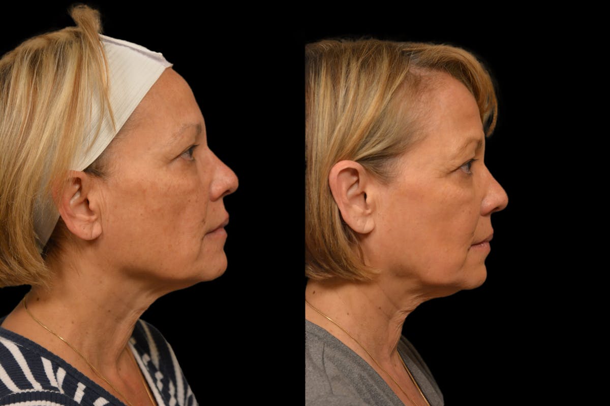 Chemical Peels Before & After Gallery - Patient 317205 - Image 3