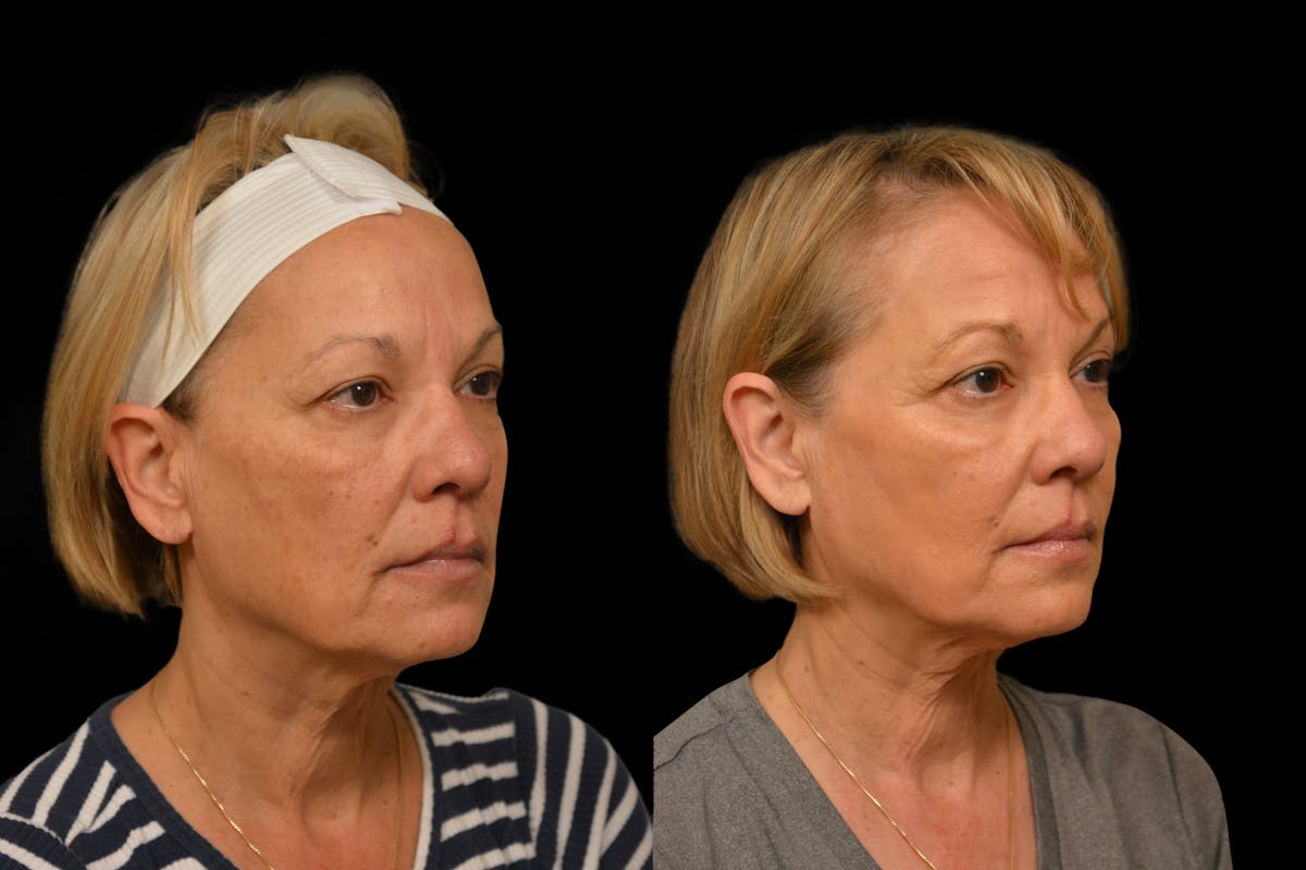 Chemical Peels Before & After Gallery - Patient 317205 - Image 4