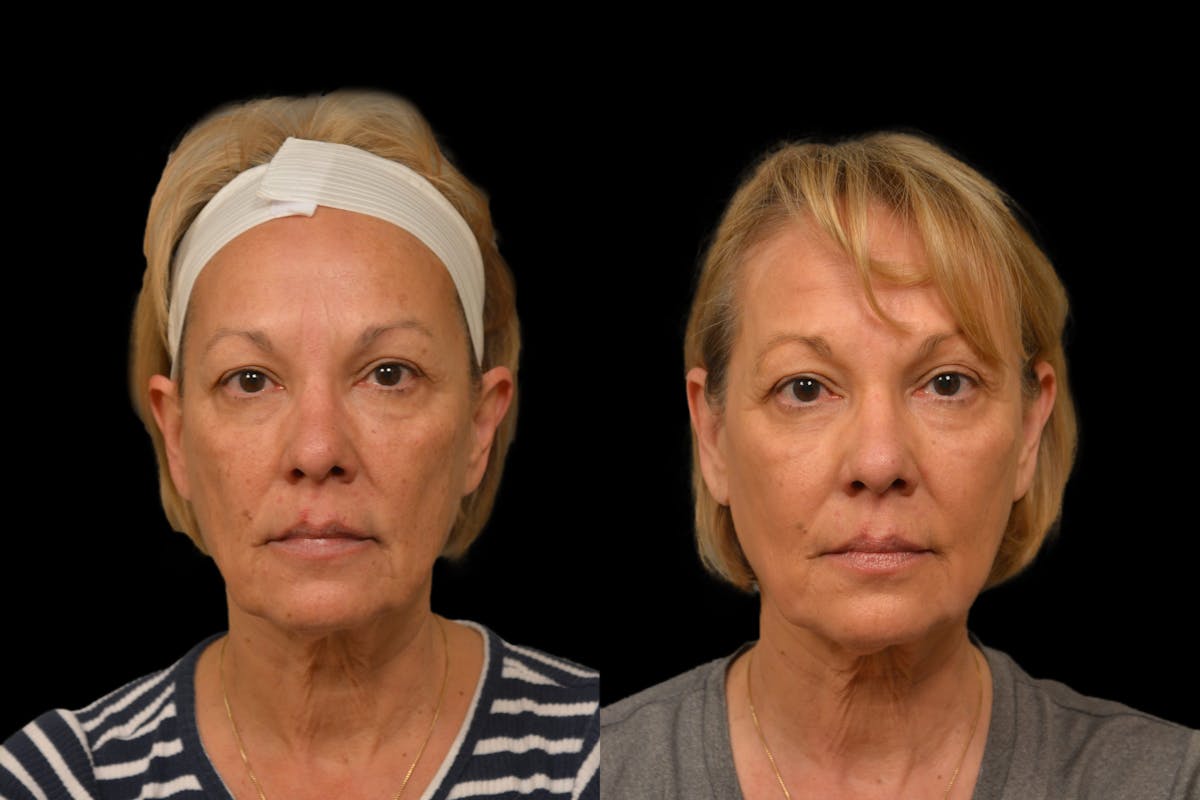 Chemical Peels Before & After Gallery - Patient 317205 - Image 5