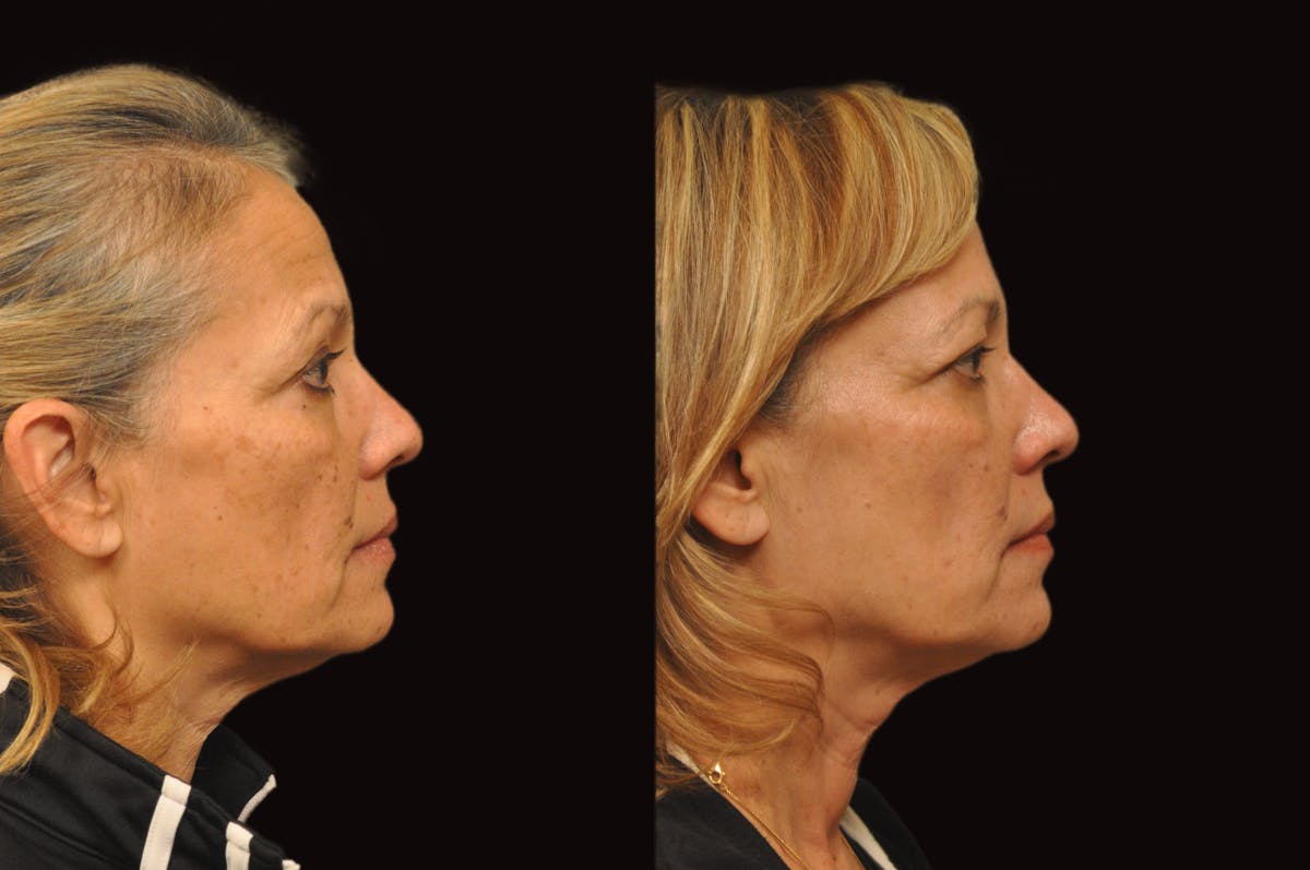 Lasers Before & After Gallery - Patient 993910 - Image 3