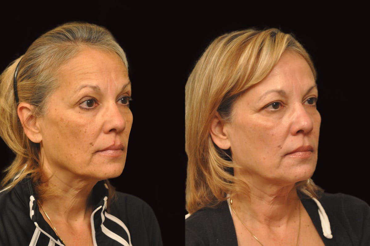 Lasers Before & After Gallery - Patient 993910 - Image 4