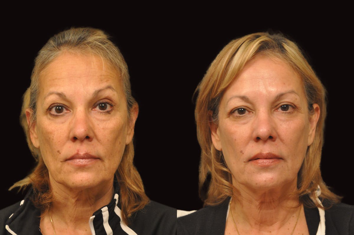 Lasers Before & After Gallery - Patient 993910 - Image 5
