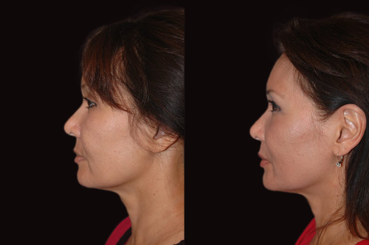 Lasers Before & After Gallery - Patient 734759 - Image 2
