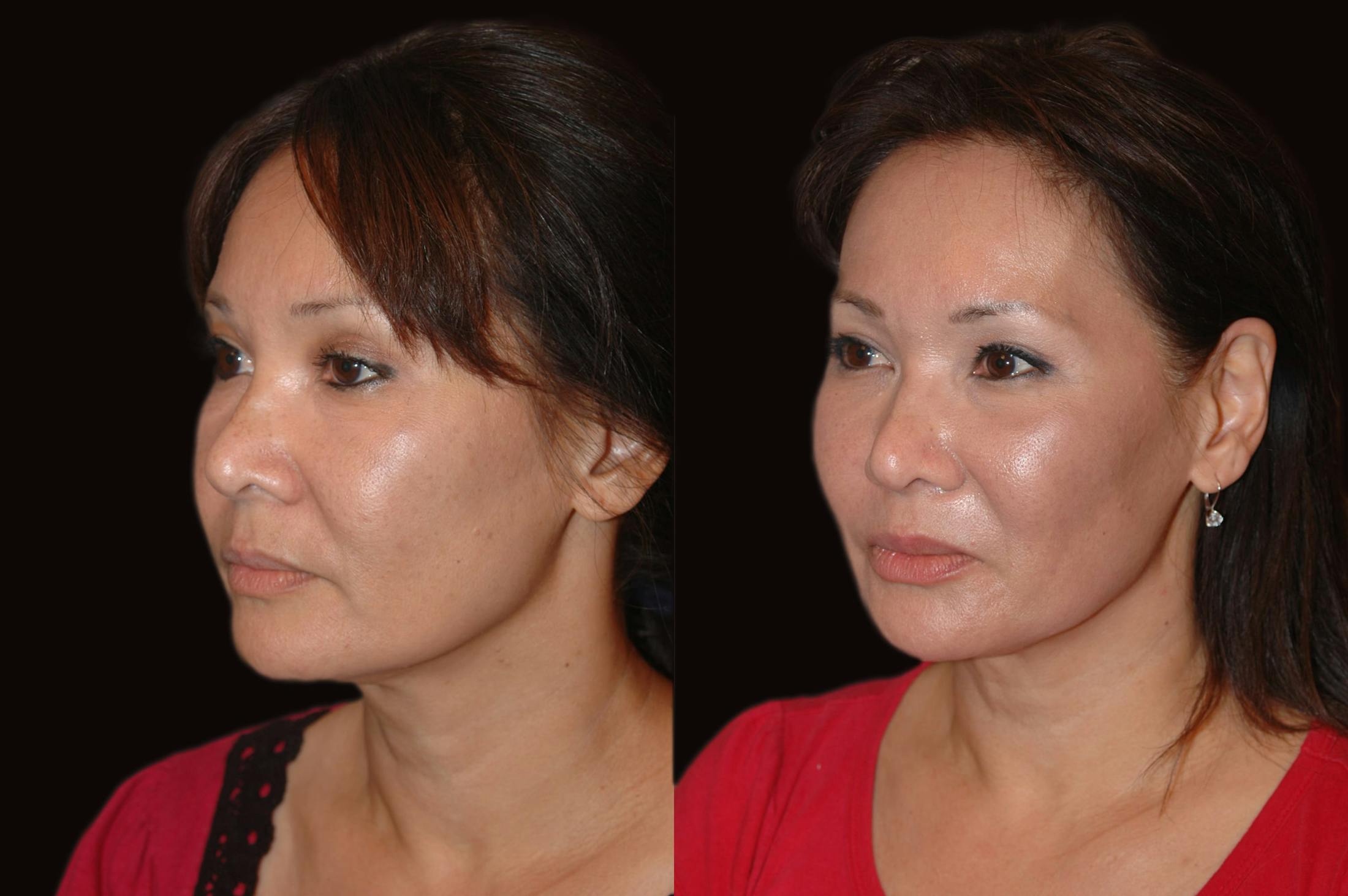 Lasers Before & After Gallery - Patient 734759 - Image 1