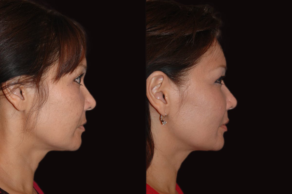 Lasers Before & After Gallery - Patient 734759 - Image 3