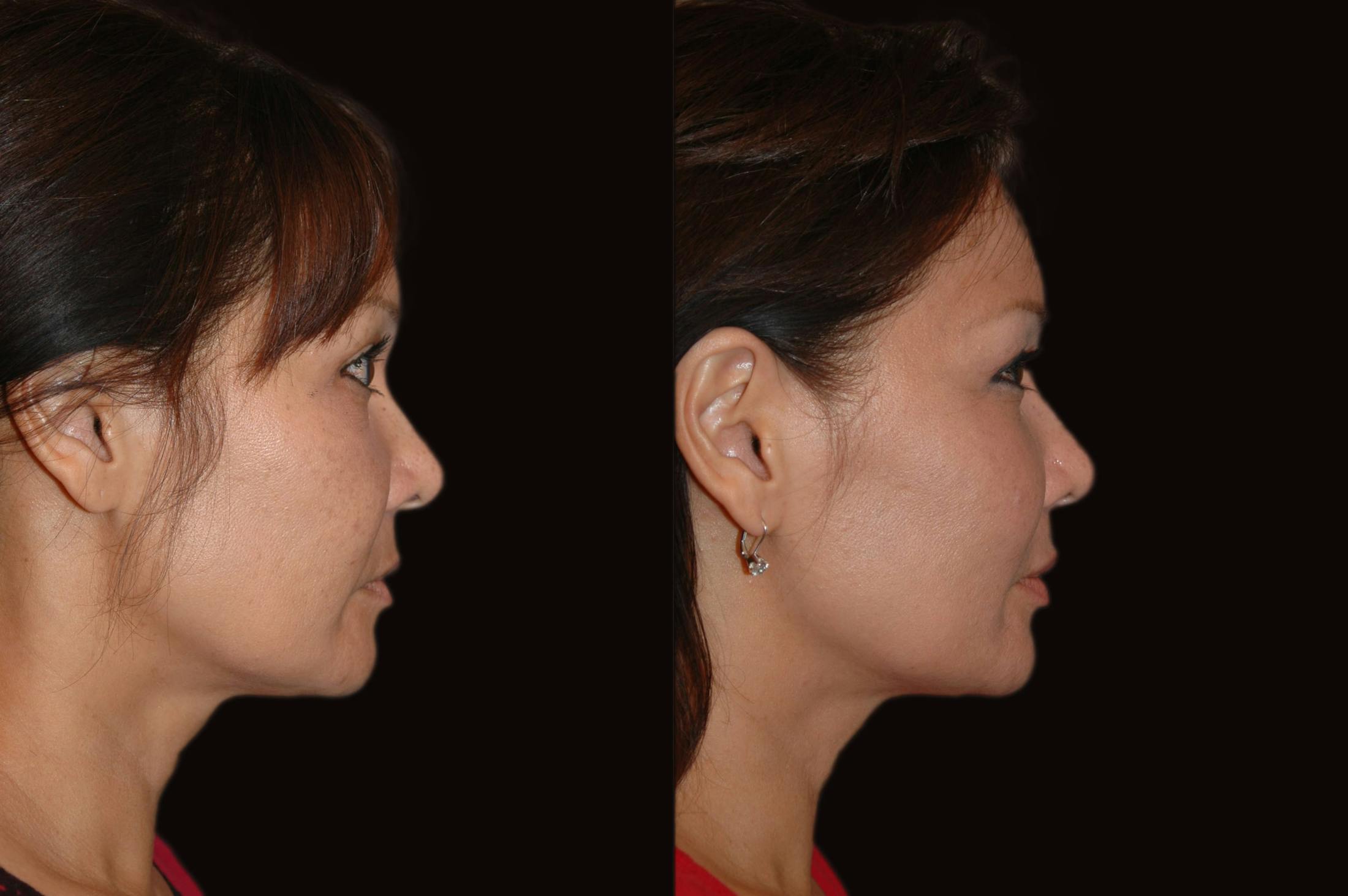 Lasers Before & After Gallery - Patient 734759 - Image 3