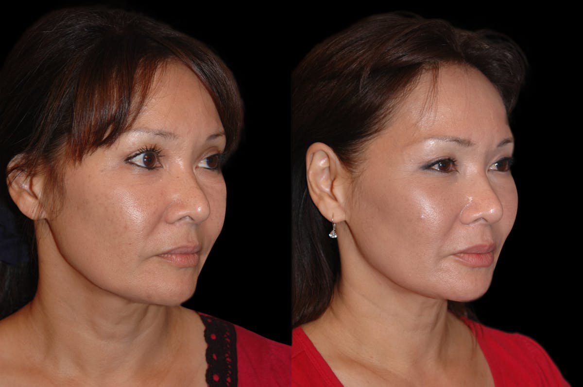 Lasers Before & After Gallery - Patient 734759 - Image 4