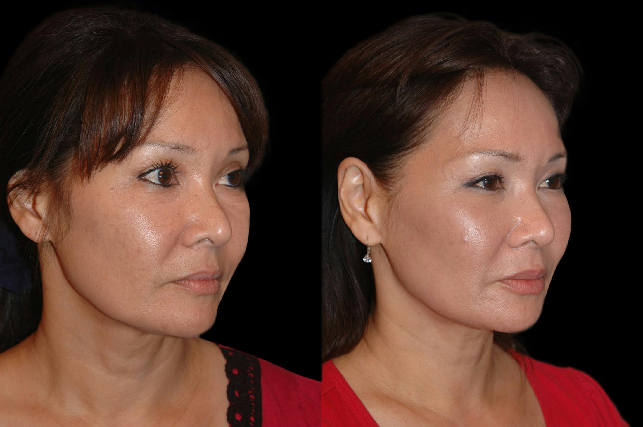 Lasers Before & After Gallery - Patient 734759 - Image 4